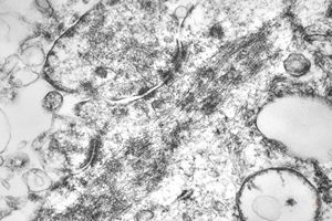 F,45y. | myo-fibrosarcoma - thigh F,45y. | myo-fibrosarcoma - thigh